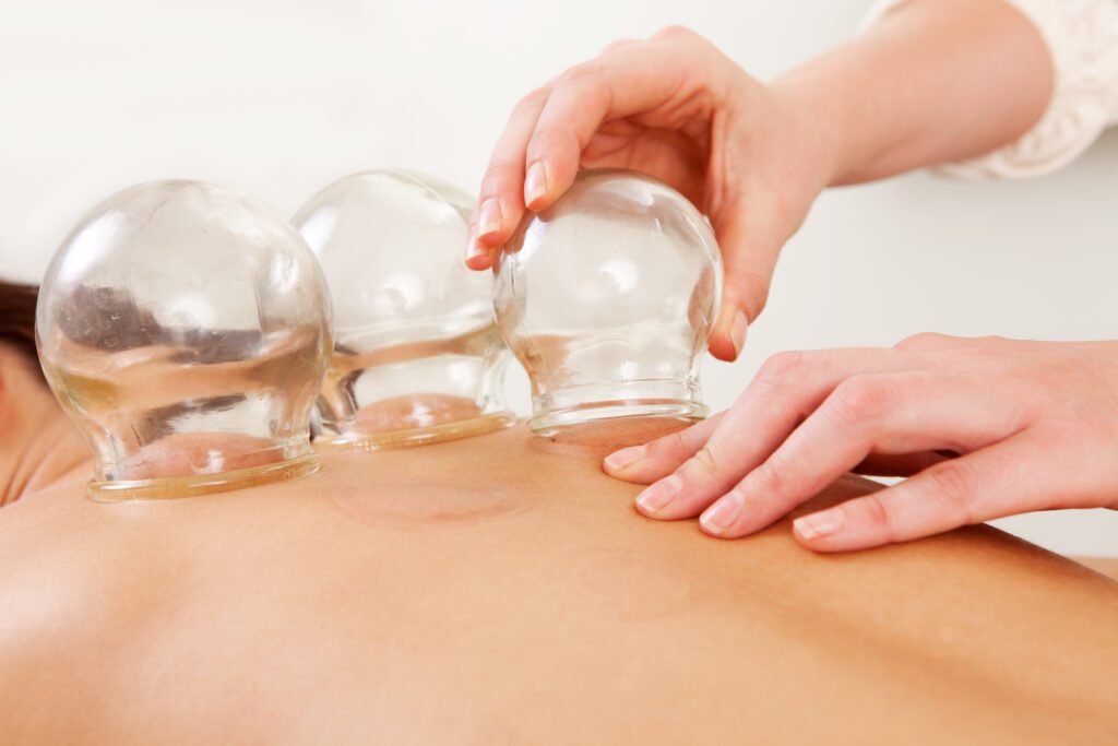 Cupping Therapy-Simple Cures